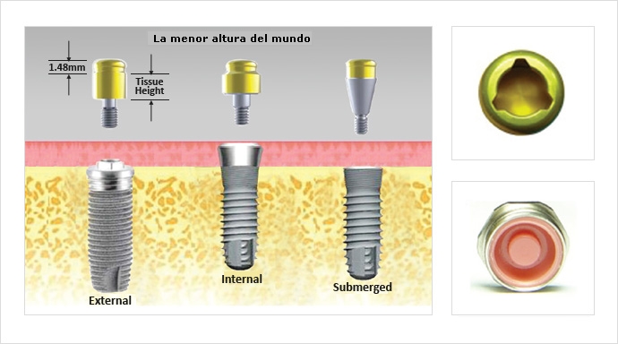 Anclajes Kerator® para implantes de conexión externa, interna o sumergidos